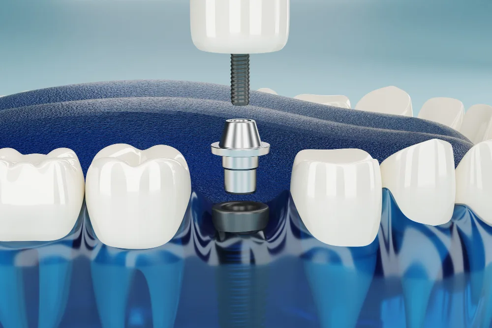 Cutaway illustration of a dental implant post being set into the jaw between two natural teeth